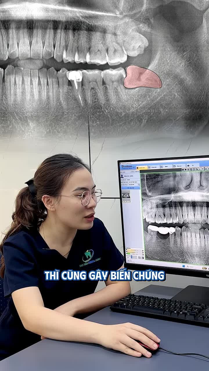 ĐAU RĂNG SỐ 7 NHƯNG “THỦ PHẠM” LẠI LÀ RĂNG KHÔN MỌC LỆCH?!
