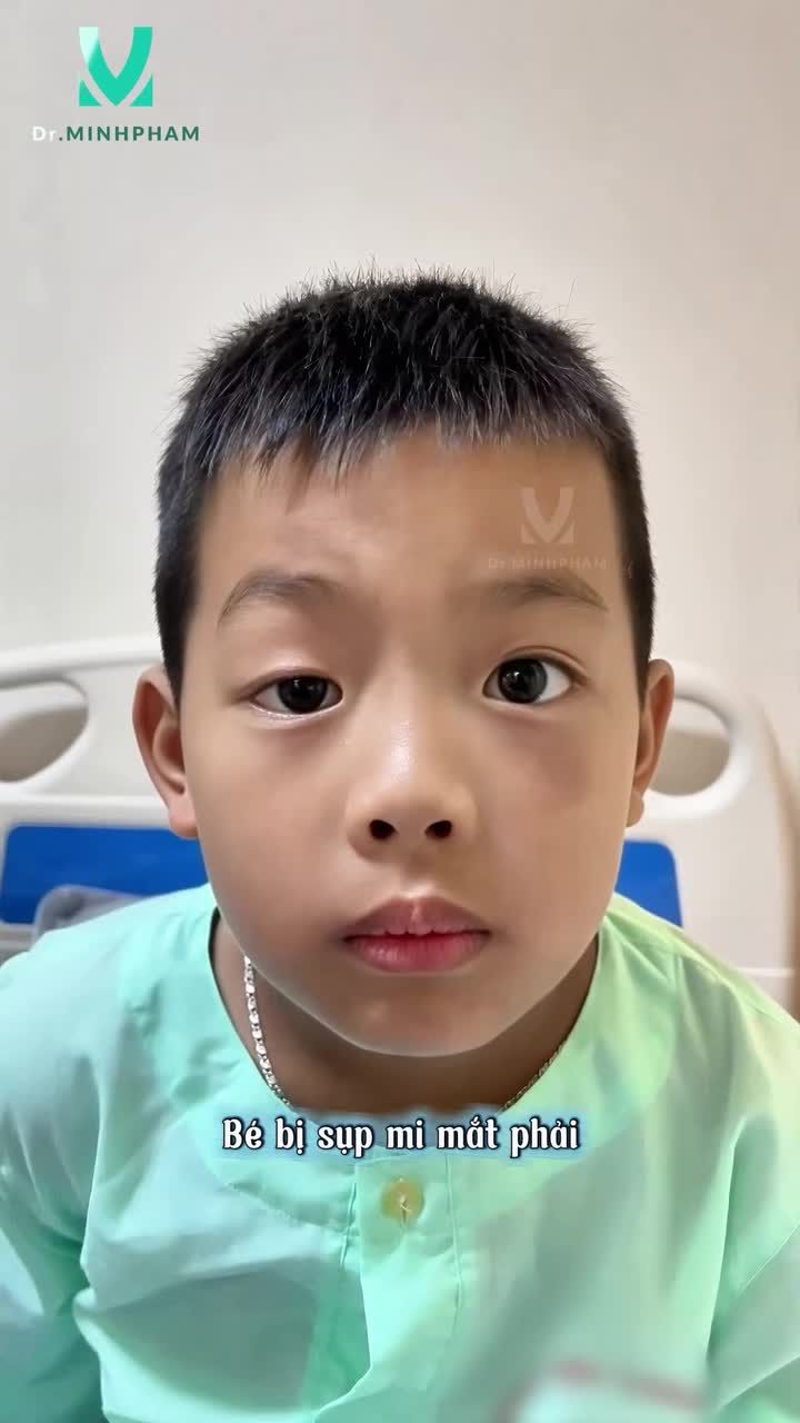 Cùng ngắm nhìn kết quả sau 8 tháng phẫu thuật treo mi vạt cơ trán của bé Quang Huy