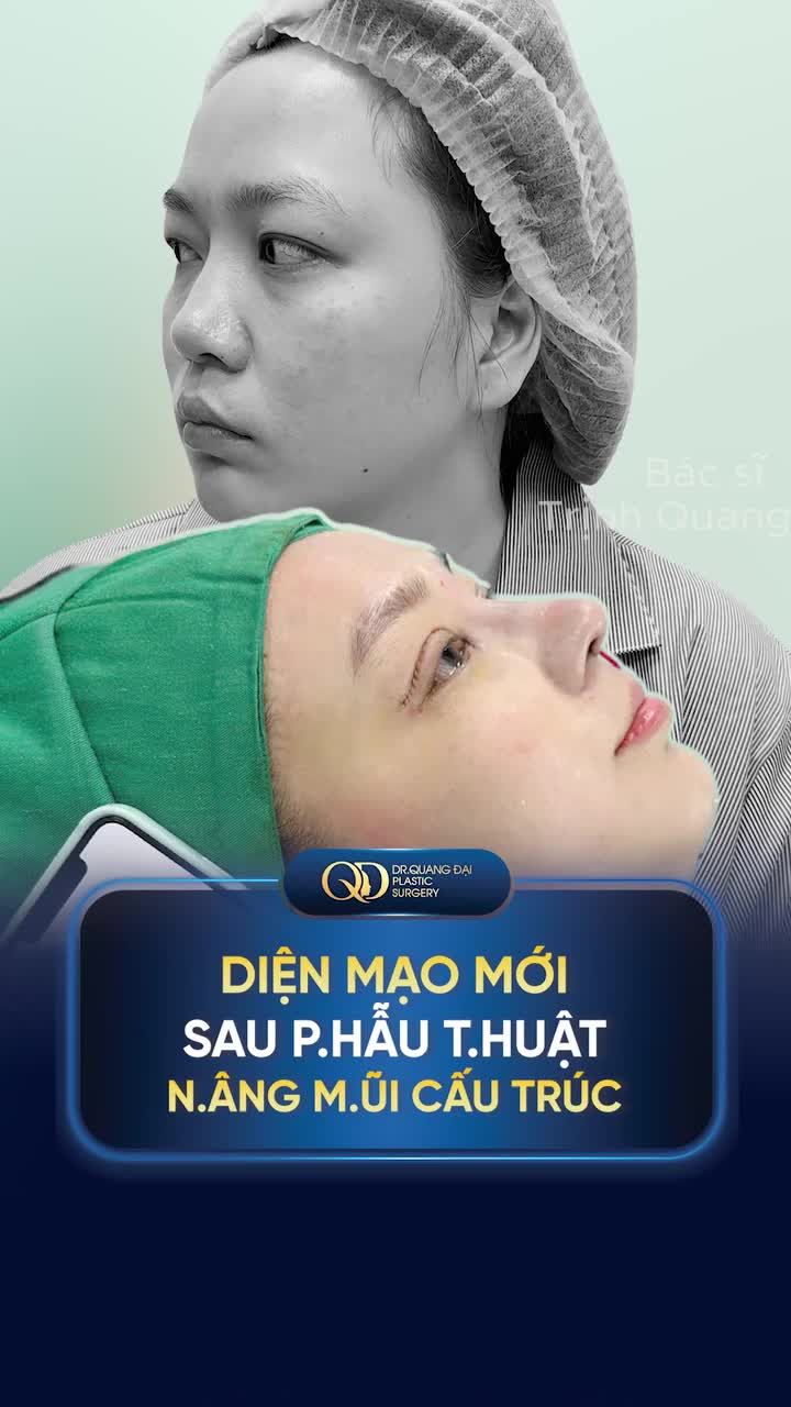 DIỆN MẠO MỚI SAU PHẪU THUẬT NÂNG MŨI CẤU TRÚC