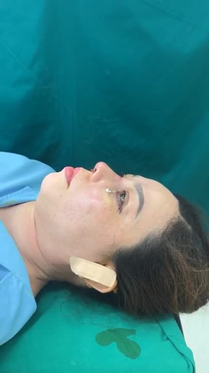 Mũi cấu trúc + cắt cấy mỡ mí dưới