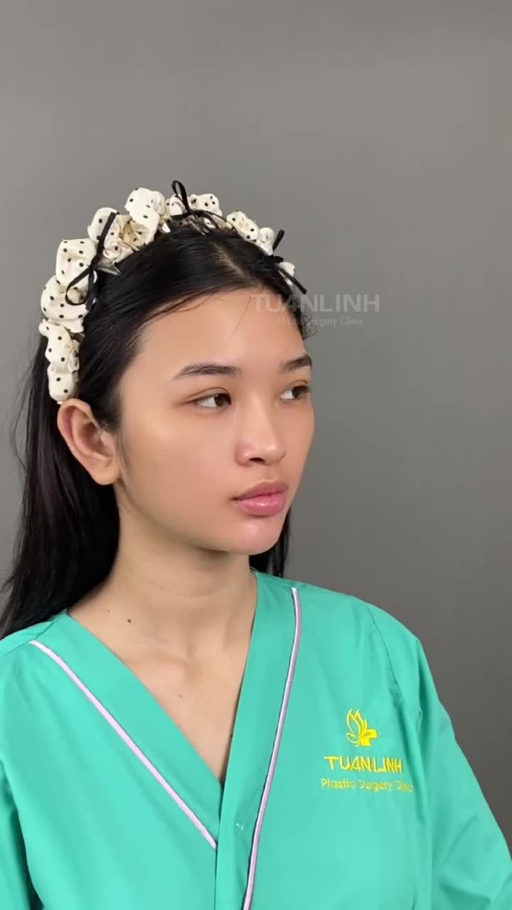 NÂNG MŨI BỌC SỤN – GIÁ CHỈ 17 TRIỆU