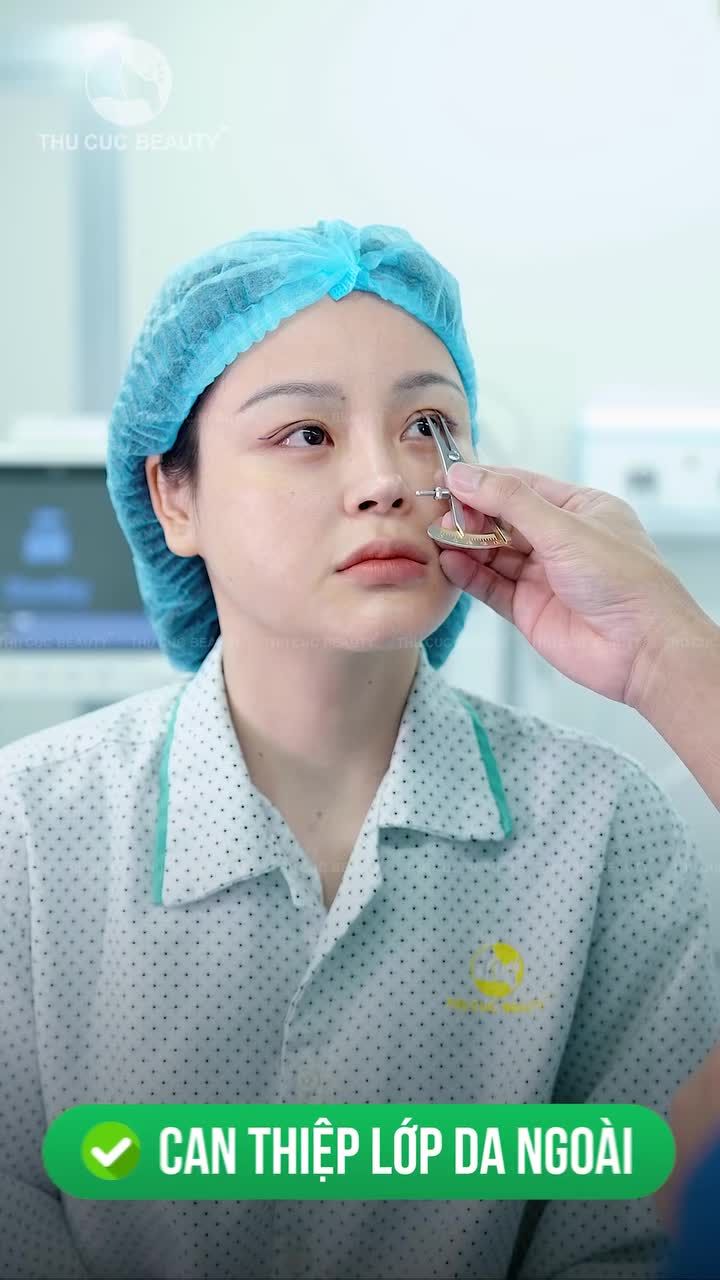 Nhiều chị em vẫn nghĩ: “Cắt mí xong mắt sẽ yếu hơn…”