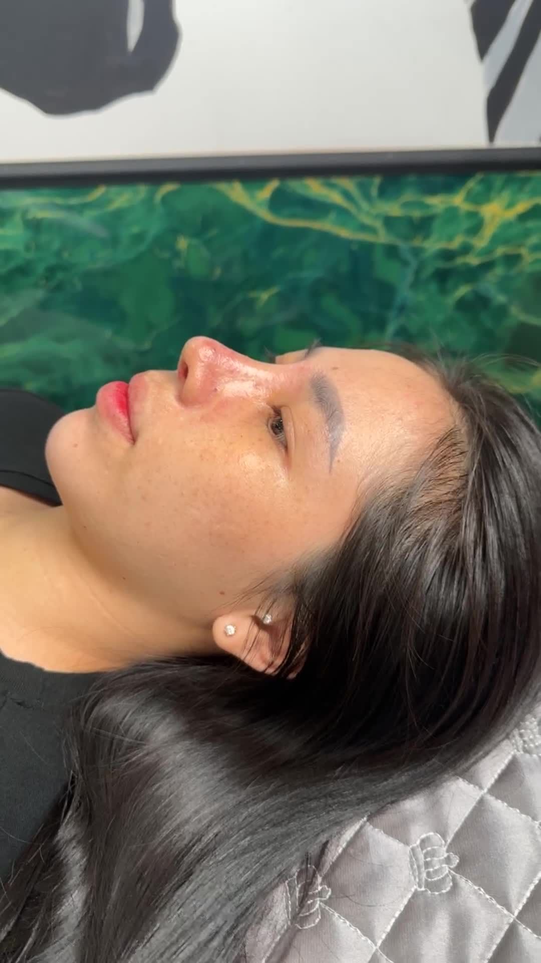 NÂNG MŨI CẤU TRÚC SAU 10 NGÀY