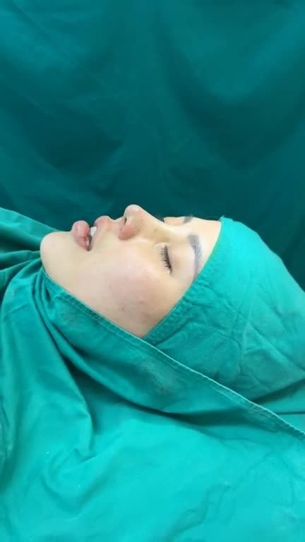 Nâng mũi bọc sụn