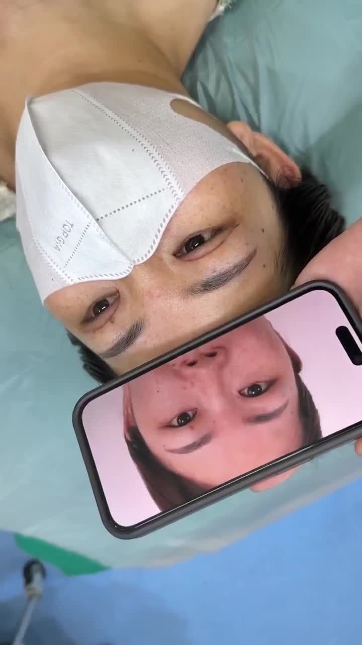 CẮT MÍ MẮT SAU 10 NGÀY SẼ NHƯ THẾ NÀO!!!