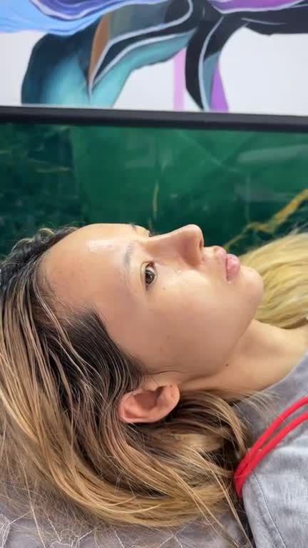 Mũi cấu trúc sau 10 ngày