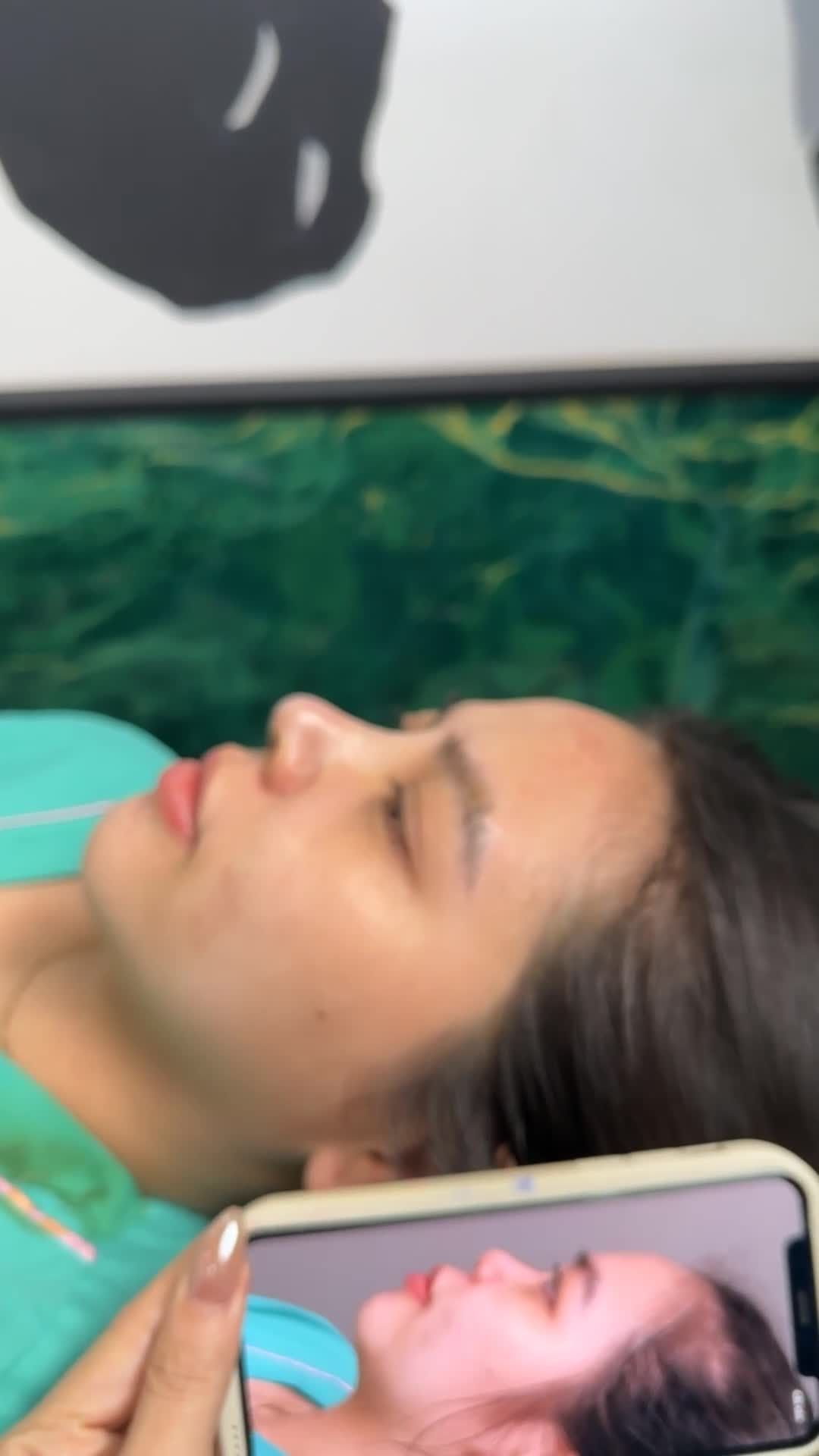 NÂNG MŨI CẤU TRÚC SAU PHẪU THUẬT