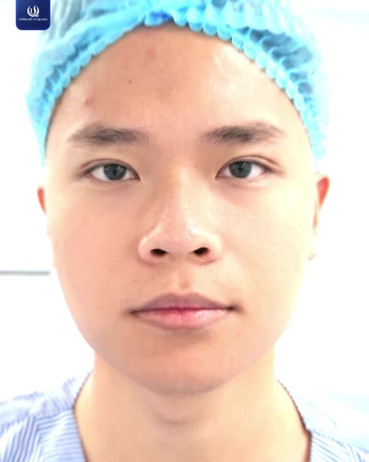 Nam giới có nên cắt mí?