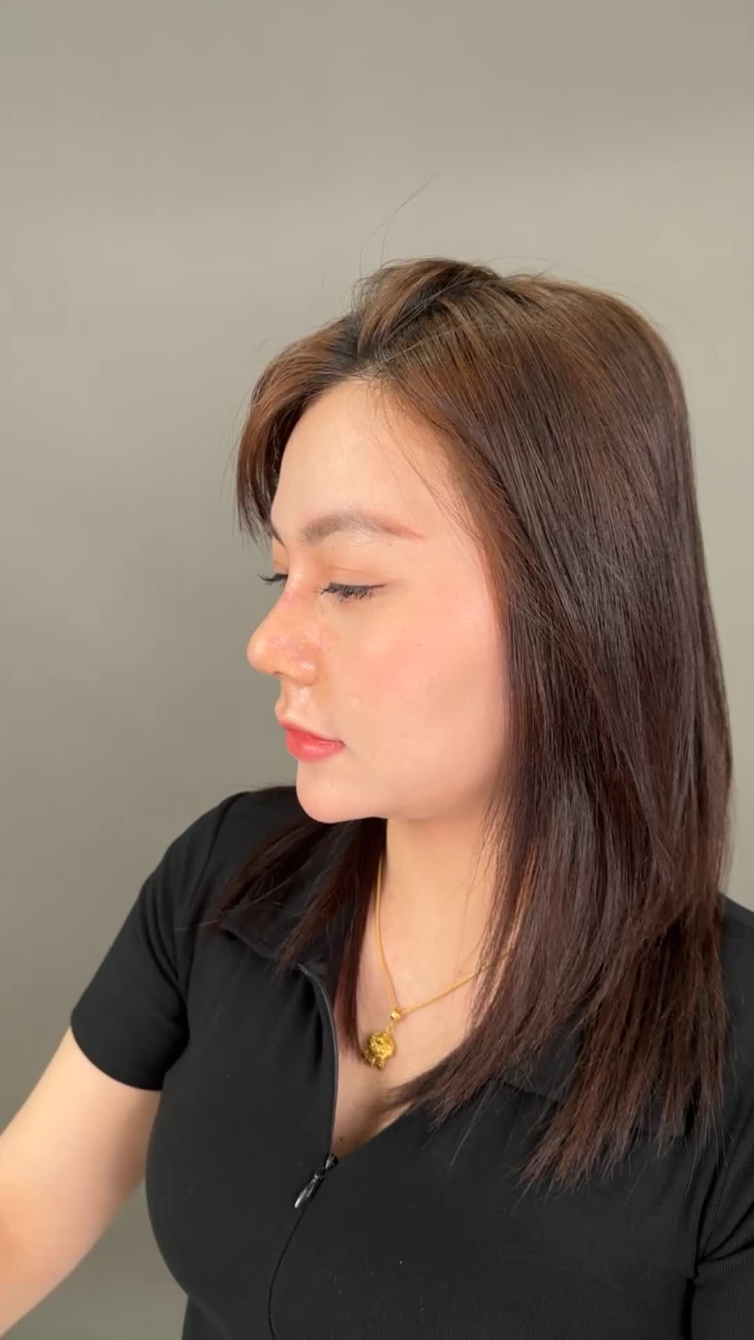 Mũi cấu trúc surgi sau 10 ngày