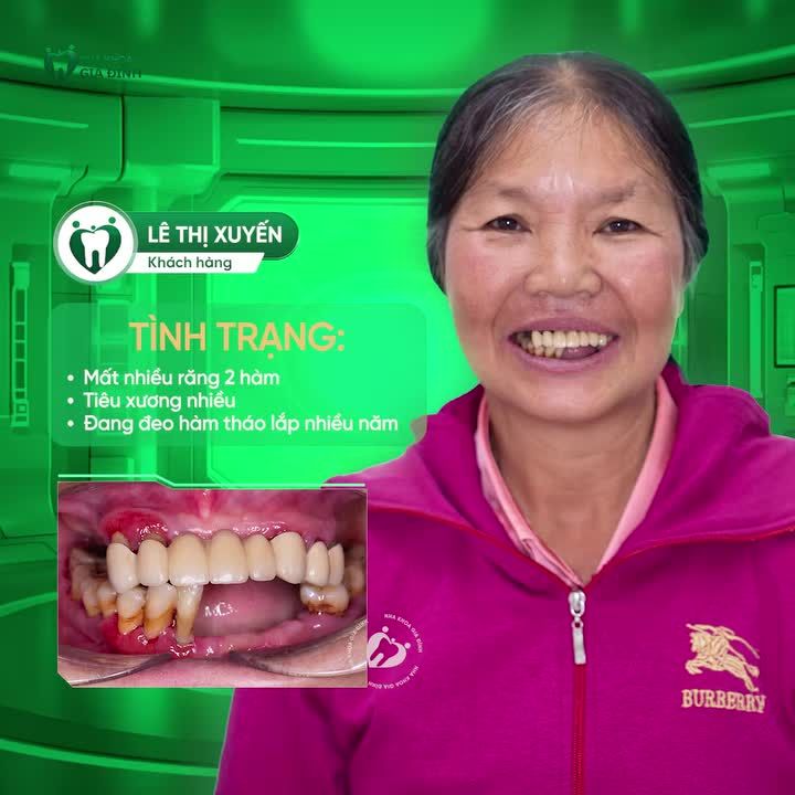 TẠM BIỆT HÀM GIẢ THÁO LẮP - CÔ XUYẾN LẤY LẠI NỤ CƯỜI TỰ TIN NHỜ IMPLANT TOÀN HÀM