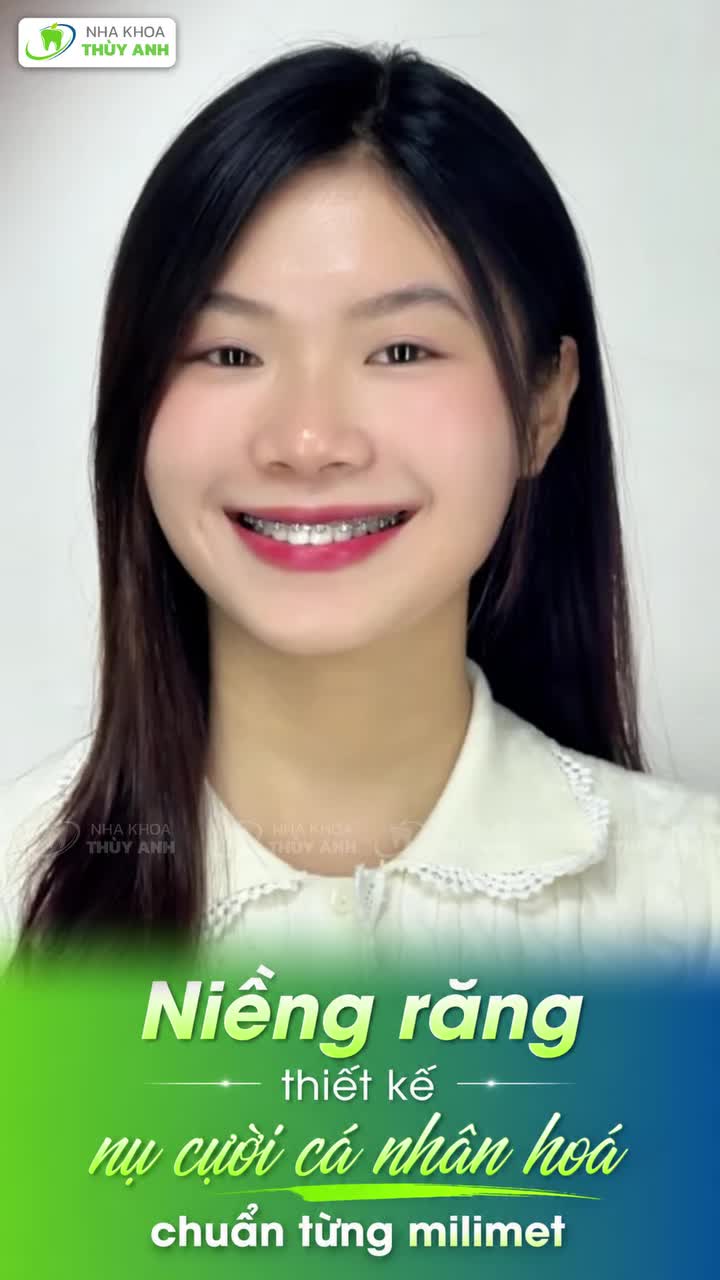 NỤ CƯỜI CỦA BẠN ĐƯỢC THIẾT KẾ CÁ NHÂN HOÁ KHI NIỀNG RĂNG TẠI NHA KHOA THUỲ ANH