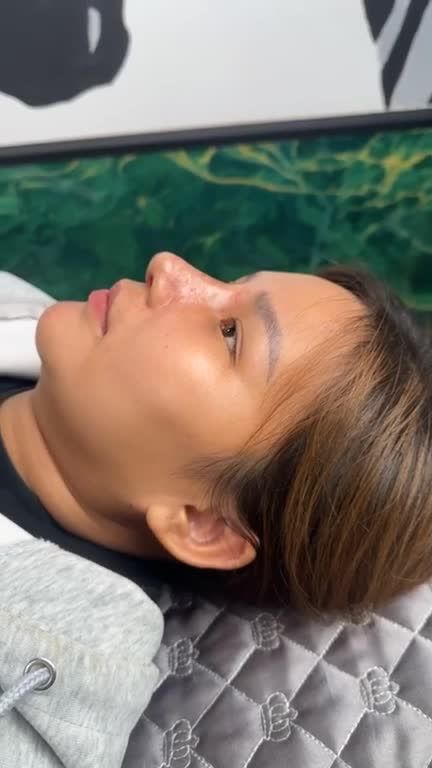 Mũi cấu trúc sửa lại surgiform