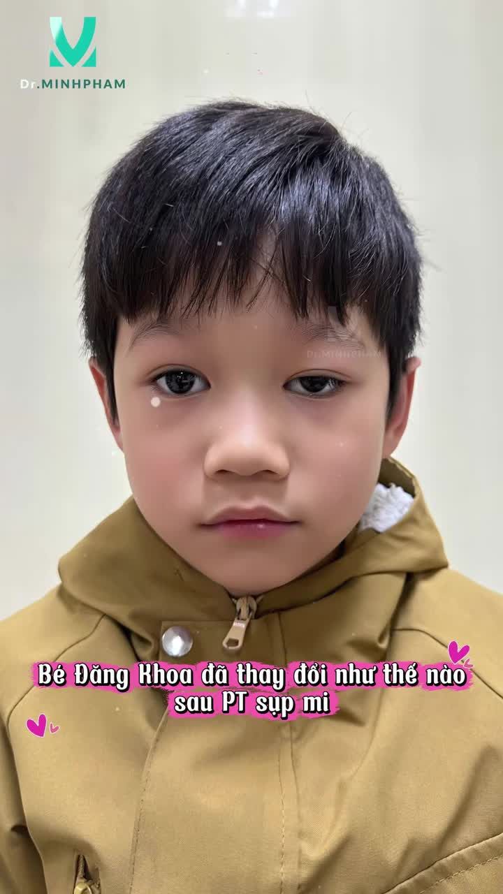 Hành trình phẫu thuật treo mi chuyển vạt cơ trán mắt trái của bé Đăng Khoa sau 4 tháng PT sụp mi  tại Dr. Minh Phạm