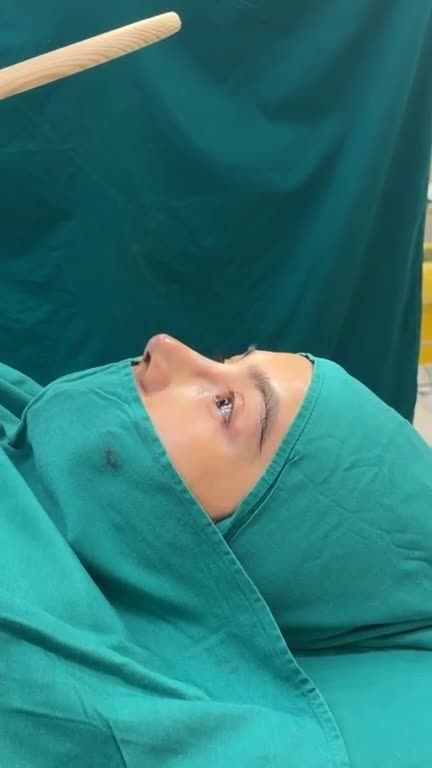 Mũi nâng tái cấu trúc Surgiform vừa hoàn thành