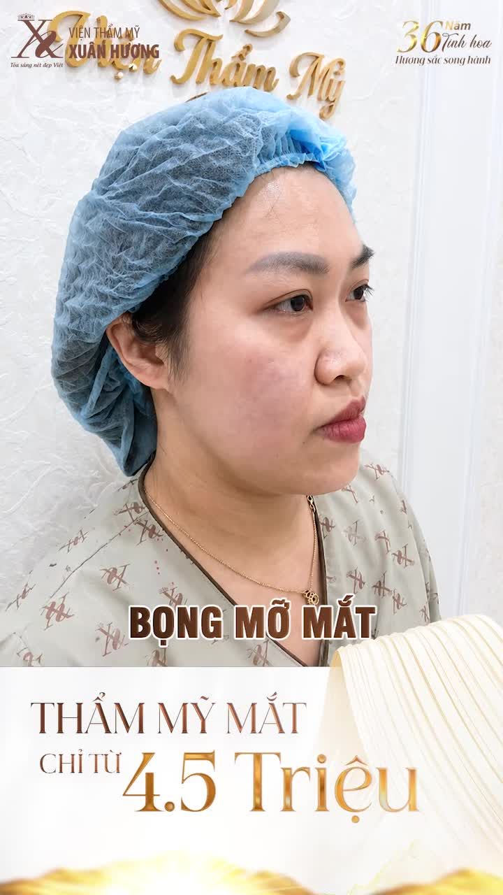 CẮT MÍ DƯỚI LOẠI BỎ BỌNG MỠ - PHƯƠNG PHÁP "HACK" TUỔI CHO GƯƠNG MẶT