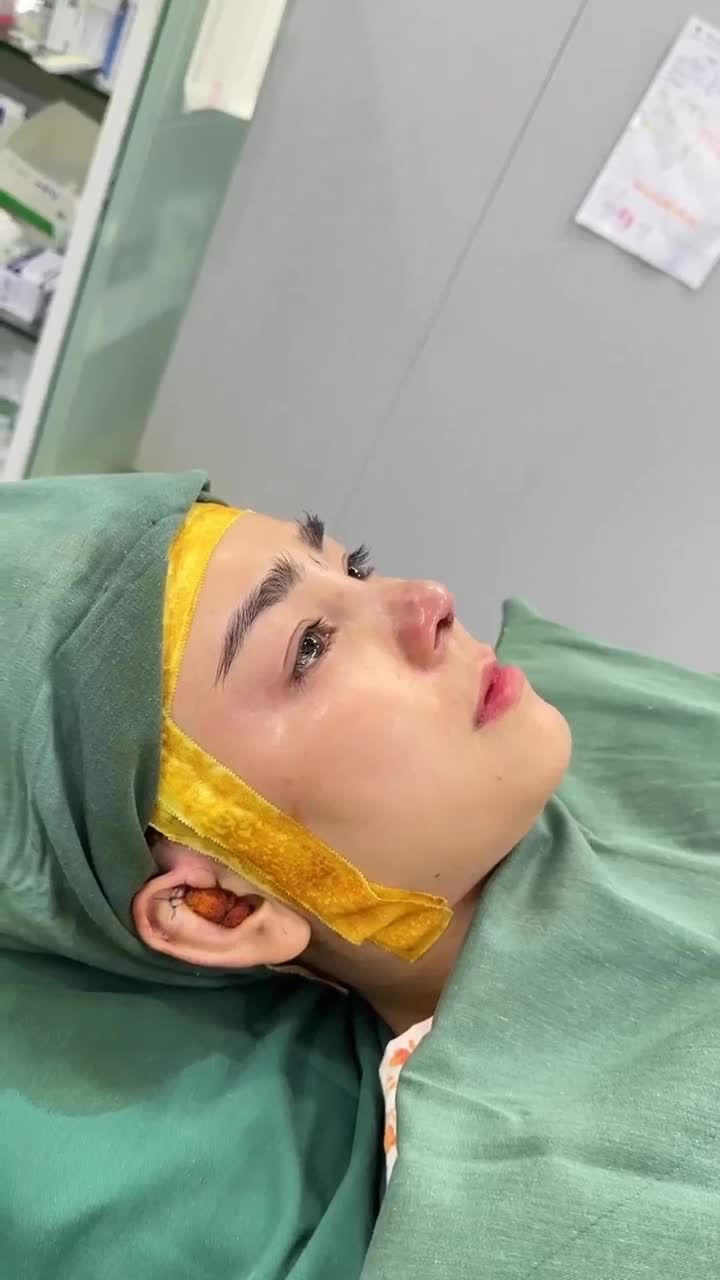 KẾT QUẢ XỬ LÝ FILLER + NÂNG MŨI CẤU TRÚC KH. THU PHƯỢNG  (AN GIANG)