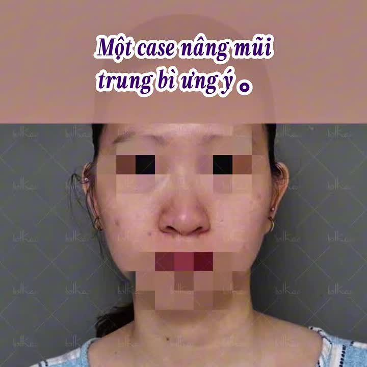 NÂNG MŨI TRUNG BÌ CÓ ĐẠT KẾT QUẢ TỐT KHÔNG?
