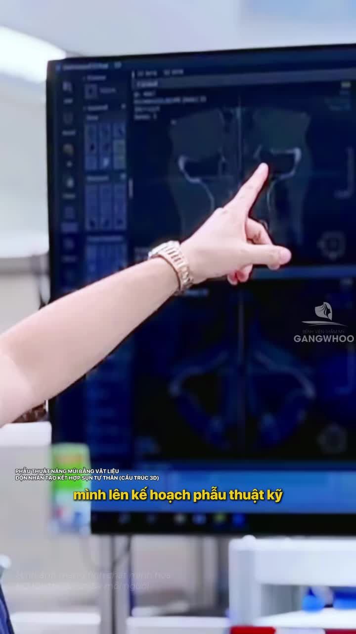 Lên kế hoạch kỹ trước phẫu thuật để mang đến dáng mũi đẹp, an toàn, bền lâu