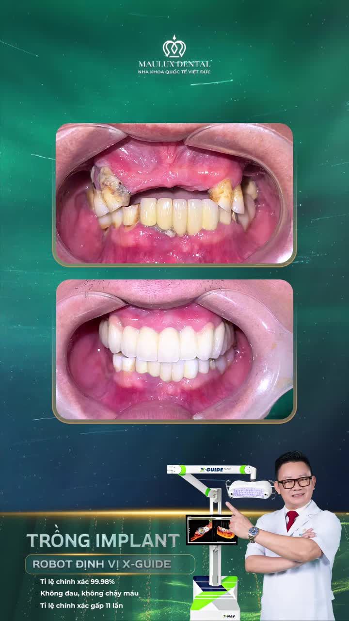 Chú Nguyễn Văn Hiển thay đổi thế nào sau trồng răng