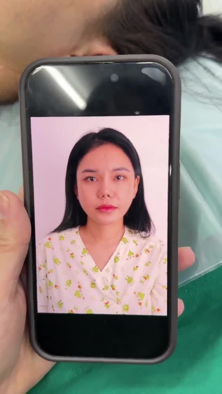 10 NGÀY SAU KHI NÂNG MŨI SẼ RA SAO???