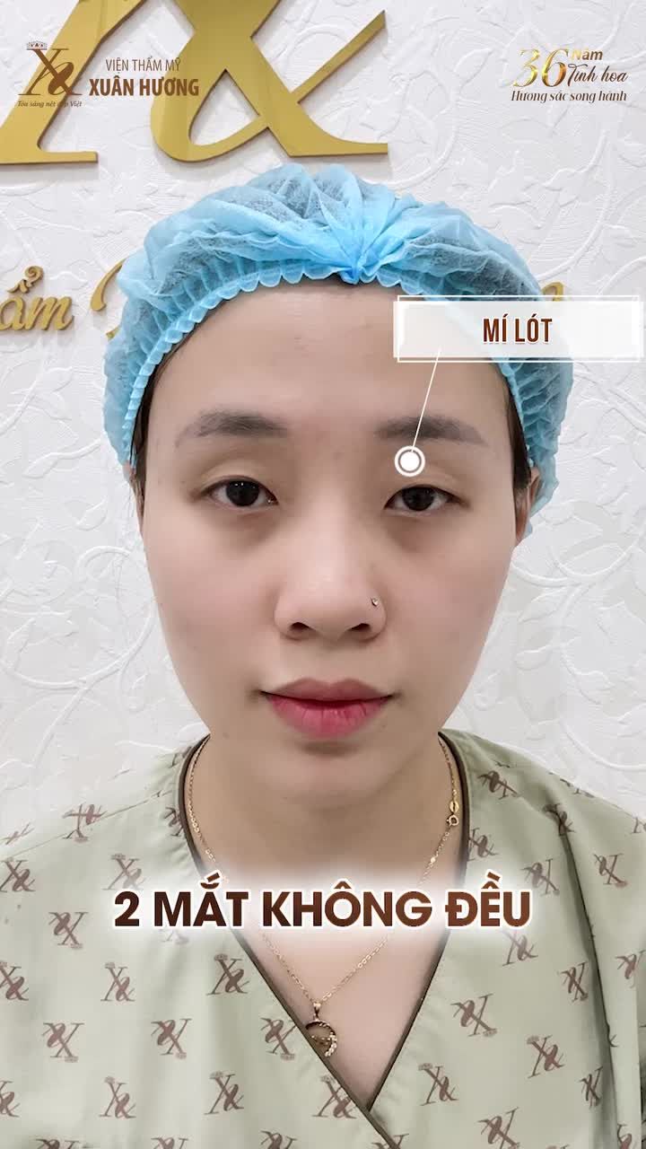 GIẢI PHÁP HOÀN HẢO CHO ĐÔI MẮT MÍ LÓT