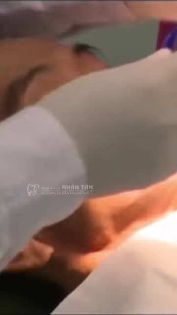 CẮM IMPLANT TRÊN NỀN XƯƠNG HÀM ĐÃ TEO HẾT SAU GẦN 4 THẬP KỶ