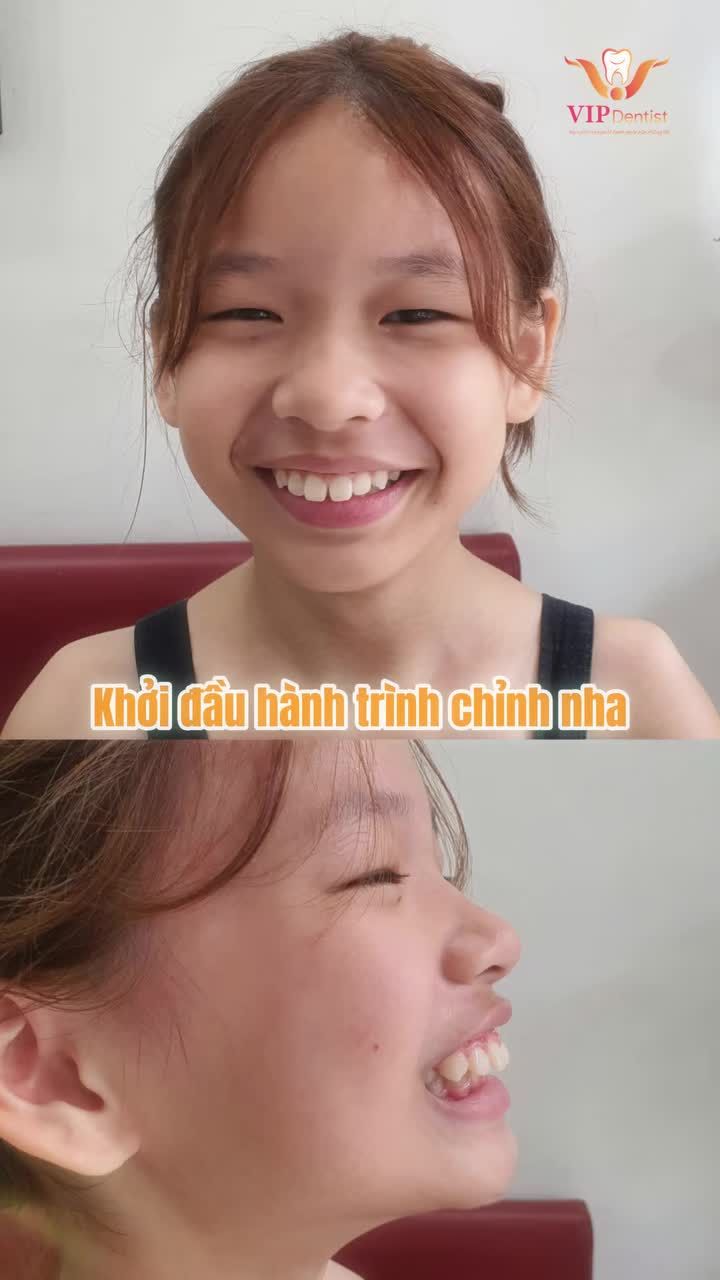 Dụi mắt 2 lần vẫn chưa tin… đây là cùng một cô bé sao?