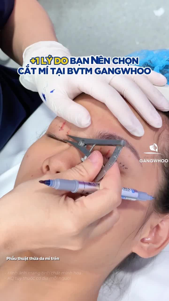 Ai nói cắt mí là phải “ở ẩn” cả tuần?