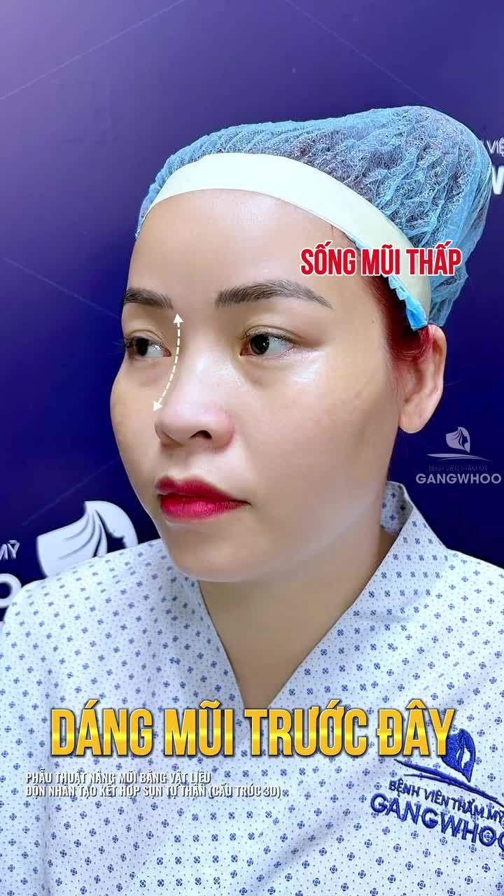 Flex nhẹ chiếc mũi mới sau 60 phút nâng mũi, 10 điểm không có nhưng