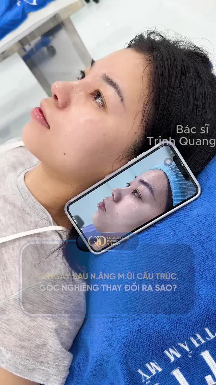 12 NGÀY SAU NÂNG MŨI CẤU TRÚC - GÓC NGHIÊNG THAY ĐỔI RA SAO?