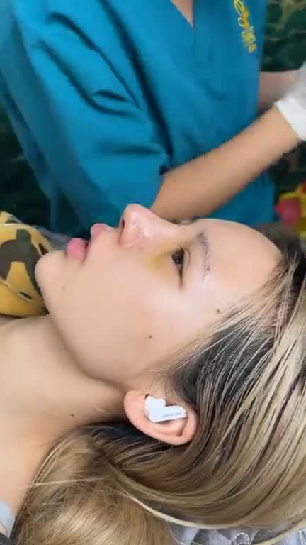 MŨI CẤU TRÚC SURGIFORM SAU 5 NGÀY - KHÁCH HÀNG ĐẾN TỪ TRUNG QUỐC– MỚI VÀI NGÀY ĐÃ THẤY KHÁC BIỆT
