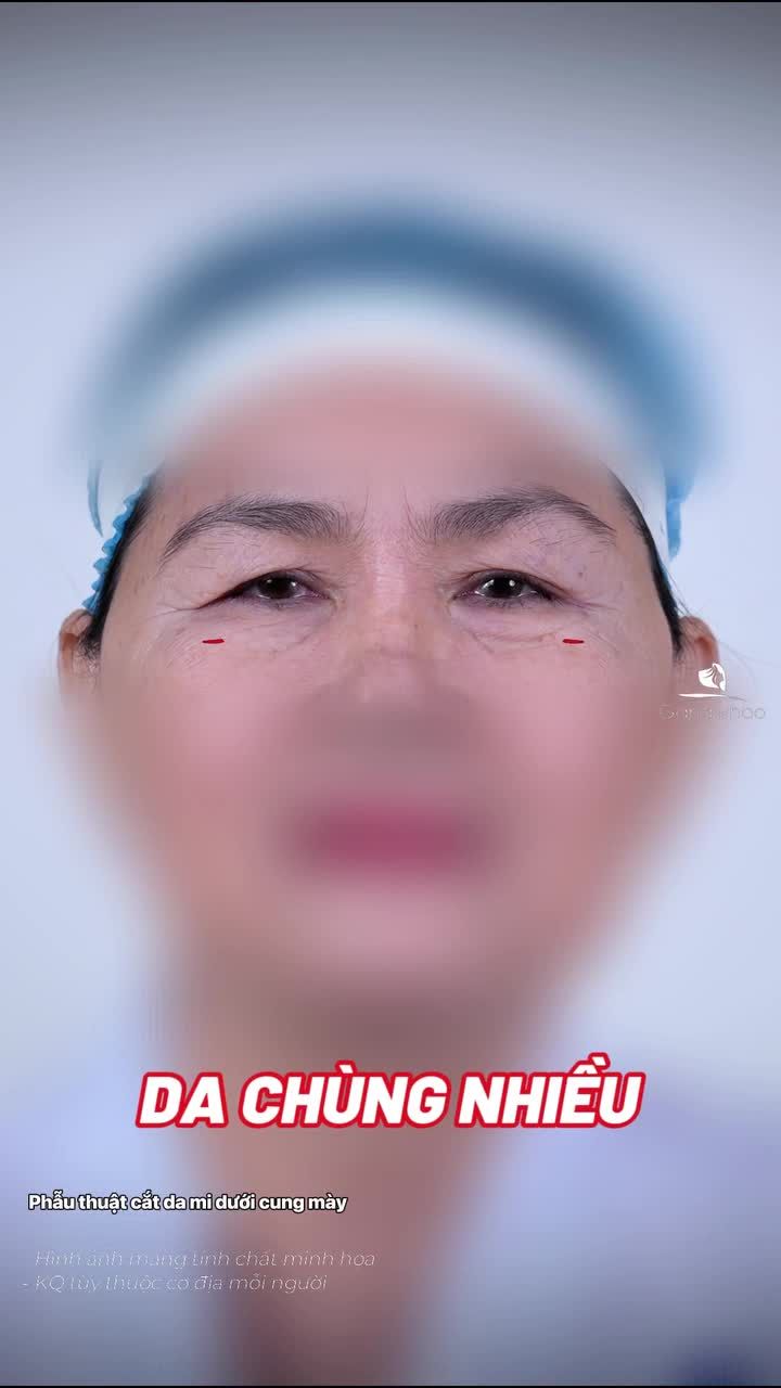 Cô khách U60 quyết định treo cung chân mày vì tình trạng lão hóa khiến mí mắt trở nên nặng nề, sa trễ và che khuất ánh nhìn. Cùng xem sự khác biệt trước - sau khi thực hiện của cô nhé.