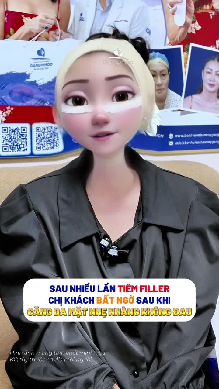 Sau nhiều lần tiêm Filler chị gái quyết định phẫu thuật căng da mặt toàn phần + Smas nội soi 4K để có diện mạo trẻ hóa bền lâu hơn