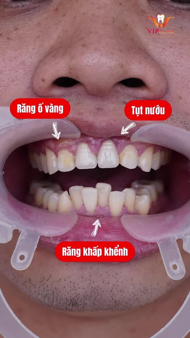 TẠM BIỆT RĂNG KHẤP KHỂNH, VIÊM LỢI - CHÀO ĐÓN DIỆN MẠO "SOÁI CA" MỚI!
