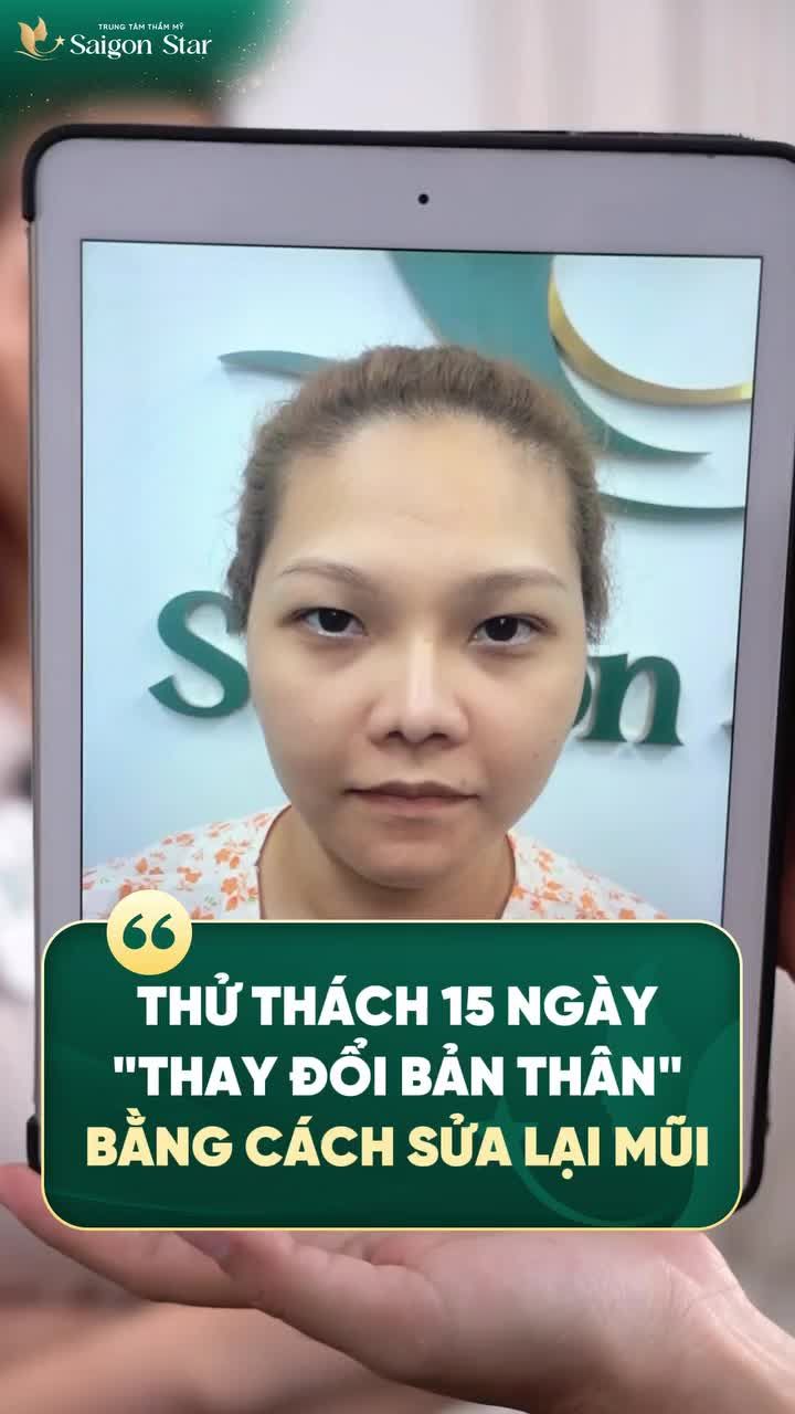 CHÚC MỪNG BẠN HELLEN (VIỆT KIỀU MỸ) ĐÃ HOÀN THÀNH THỬ THÁCH "15 NGÀY THAY ĐỔI BẢN THÂN" CÙNG NÂNG MŨI CẤU TRÚC DR. HOẠT!!!