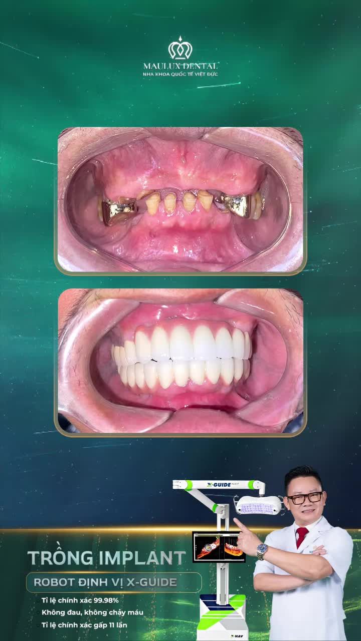 Chú Nguyễn Văn Tẻn lấy lại nụ cười khỏe mạnh sau trồng răng