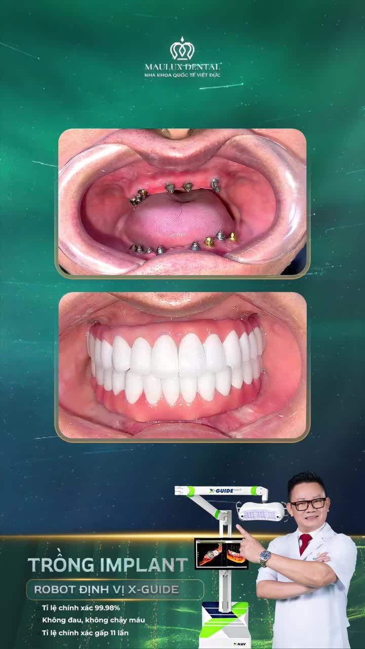 Mất răng toàn hàm có trồng được Implant không?