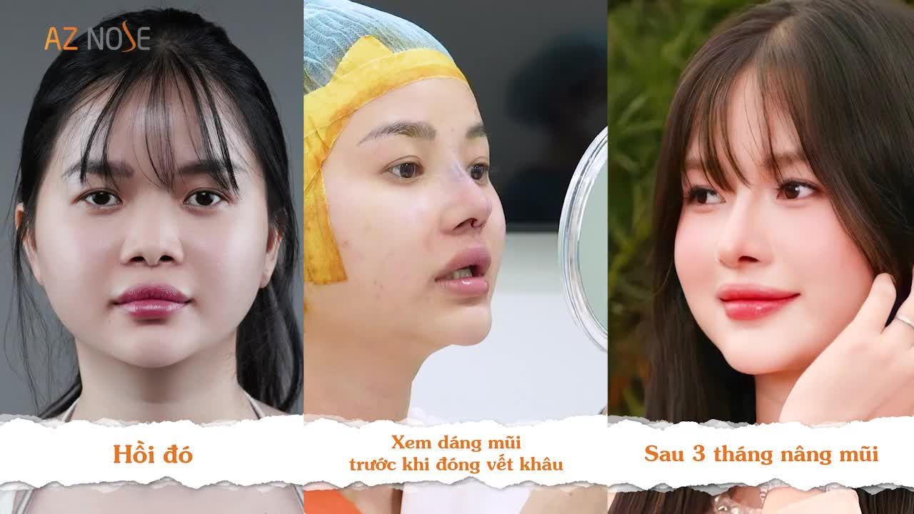 Khách hàng 9X chọn nâng mũi cấu trúc để cải thiện tình trạng mũi kém hài hoà do từng t.iêm filler.