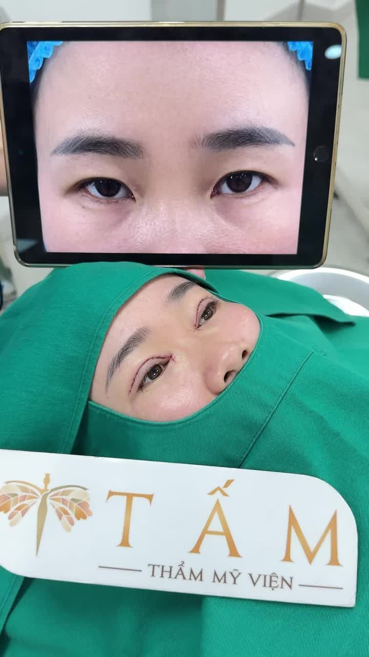 Đôi mắt 1 mí từng khiến khách hàng thiếu tự tin. Chỉ sau 45 phút với combo Cắt mí + Mở góc trong tại TMV Tấm, đôi mắt “hô biến” đầy ấn tượng . Nếp mí rõ nét hơn, ánh nhìn tươi trẻ và cuốn hút hơn.