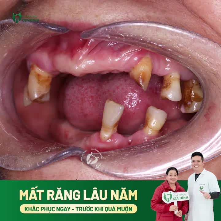 ĐỂ MẤT RĂNG QUÁ LÂU - KHẮC PHỤC NGAY TRƯỚC KHI QUÁ MUỘN