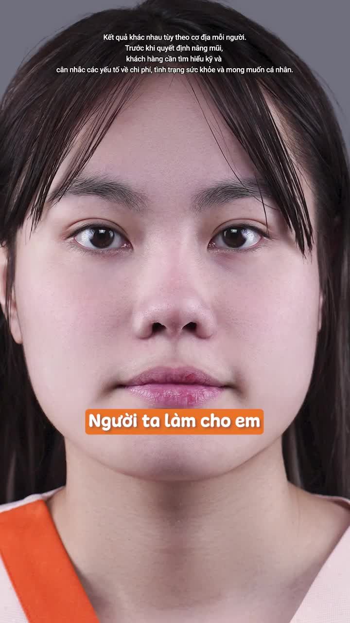 GenZ đến từ USA muốn cải thiện tình trạng "đầu mũi to" và đây là kết quả sau 2 tháng nâng mũi cấu trúc tại AZNOSE!