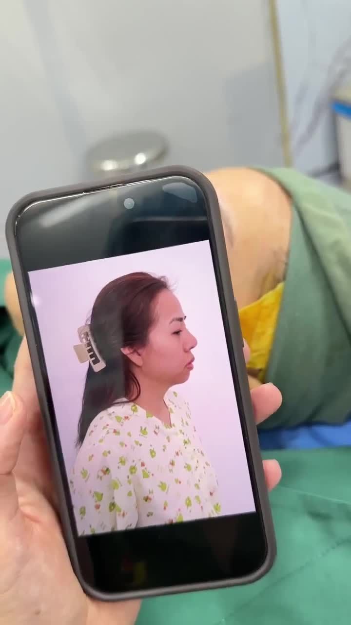 KẾT QUẢ NÂNG MŨI CẤU TRÚC SỬA LẠI DR. HOẠT