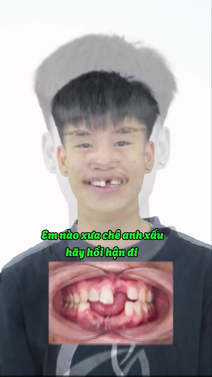 MẤT RĂNG KHÔNG CÒN LÀ NỖI LO - VÌ ĐÃ CÓ IMPLANT