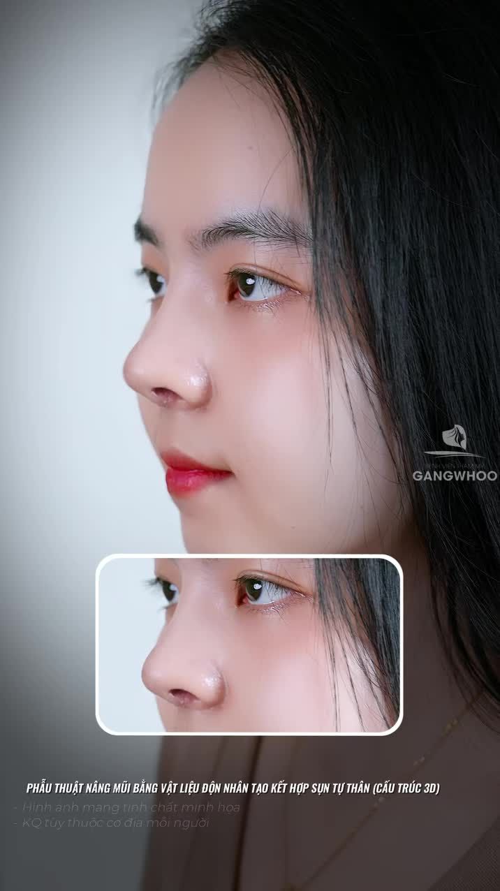 Hơn 10.000 khách hàng lột xác sau khi nâng mũi. Còn bạn thì sao?