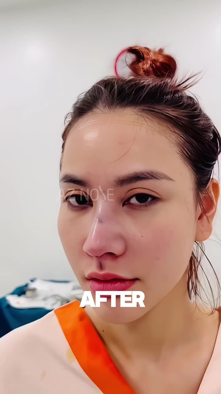 Nâng mũi cấu trúc nhưng không đặt sóng thì kết quả sẽ như thế nào? Đừng ngại liên hệ AZNOSE nếu bạn quan tâm nhé!