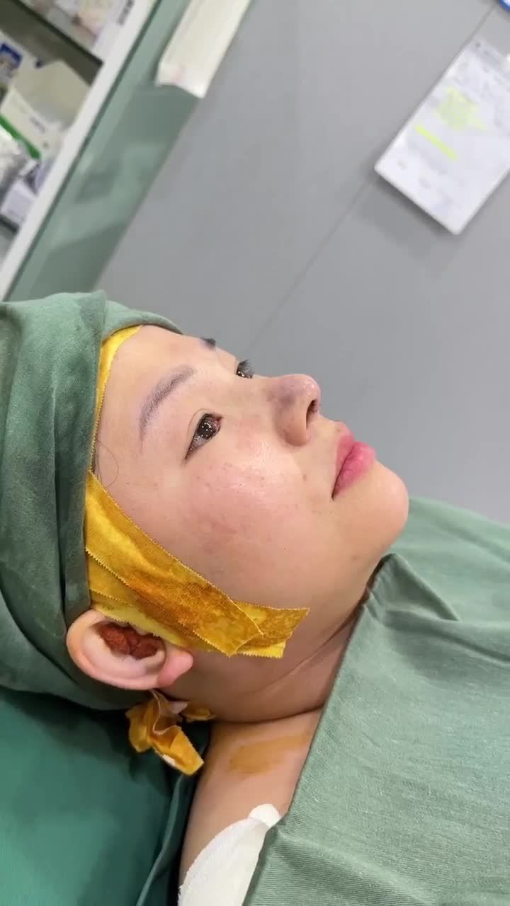 TRẢ KẾT QUẢ NÂNG MŨI CẤU TRÚC DR. HOẠT KH: CHẮNG CÓNG VĂN (HONGKONG)