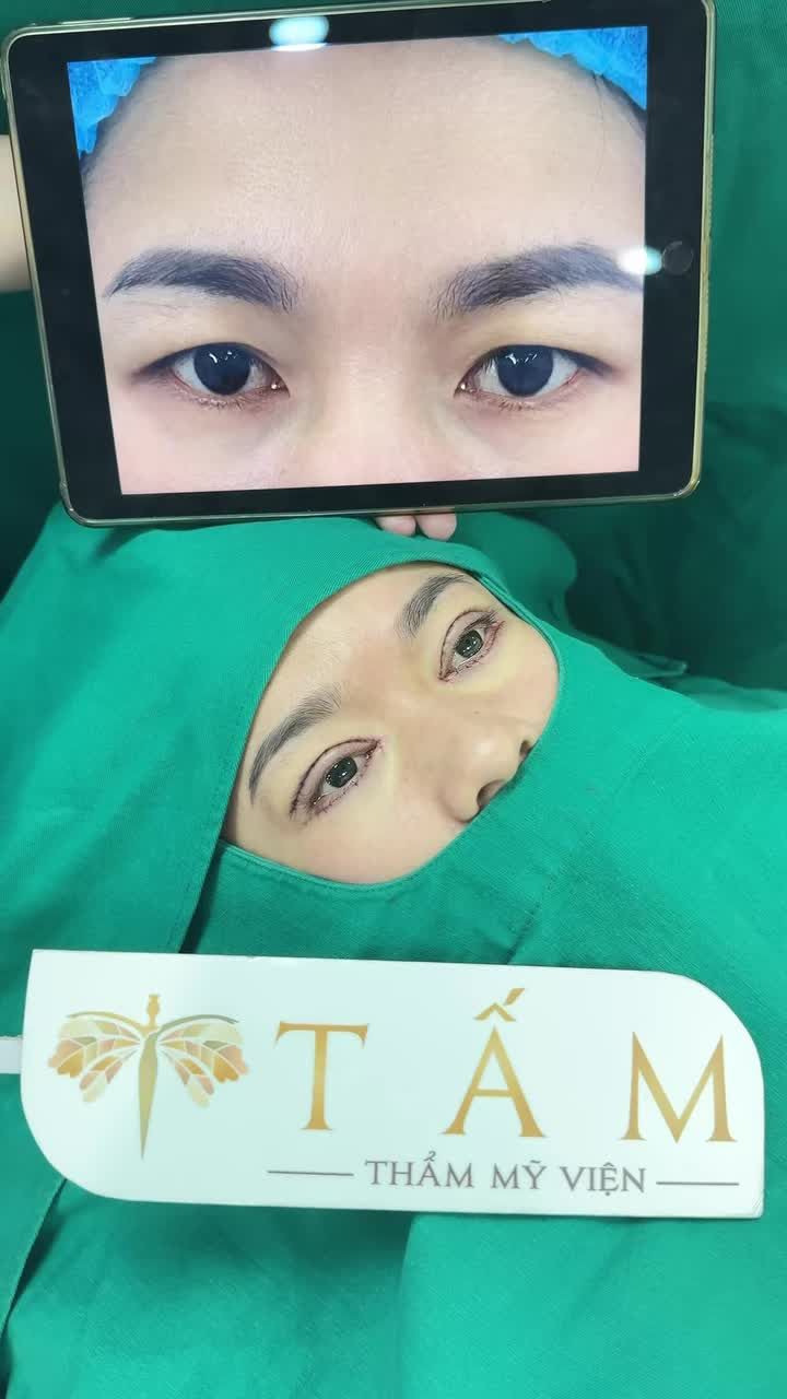 Hình ảnh khách hàng 37 tuổi với tình trạng da dư trùng nhiều, góc mắt trong có nếp rẻ quạt, độ mở mắt hạn chế