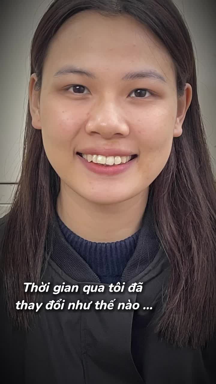 TẠM BIỆT RĂNG KHẤP KHỂNH – CHÀO NỤ CƯỜI TỰ TIN