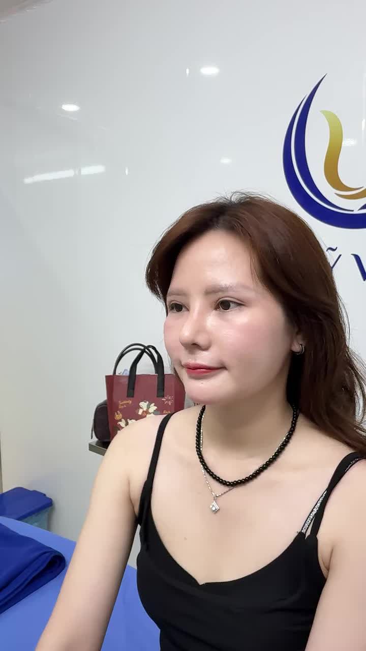Khách mũi tái khám 1 tháng hôm nay xinh quá, mũi sửa 2 lần đều lỗi và tìm tới ekip Dr Vũ Quang như này có xứng đáng k ạ?
