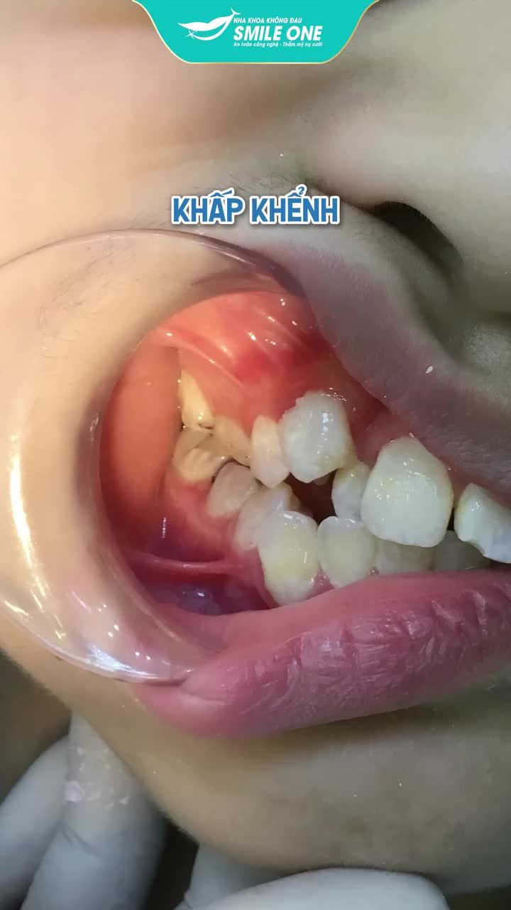 1 trong những ca dậy thì thành công nhất tại Smile One